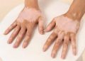 Pengertian Vitiligo Penyakit Kulit yang Banyak Dibahas di Media Sosial