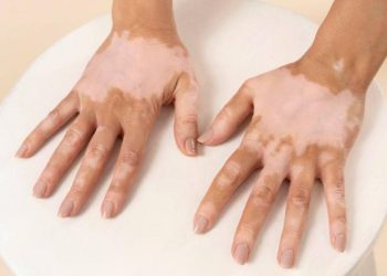 Pengertian Vitiligo Penyakit Kulit yang Banyak Dibahas di Media Sosial