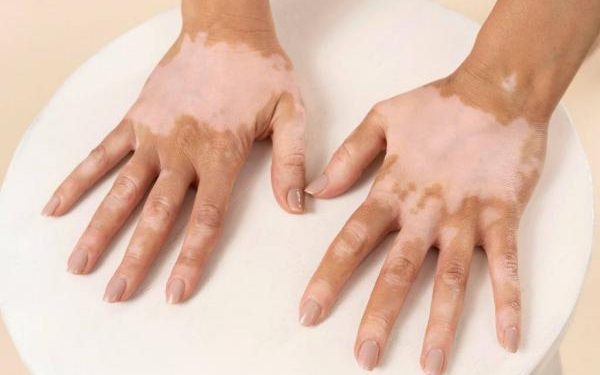 Pengertian Vitiligo Penyakit Kulit yang Banyak Dibahas di Media Sosial